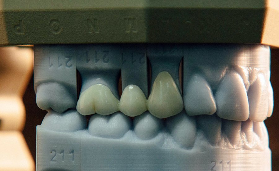 Crown and Bridge Pittman Dental Laboratory